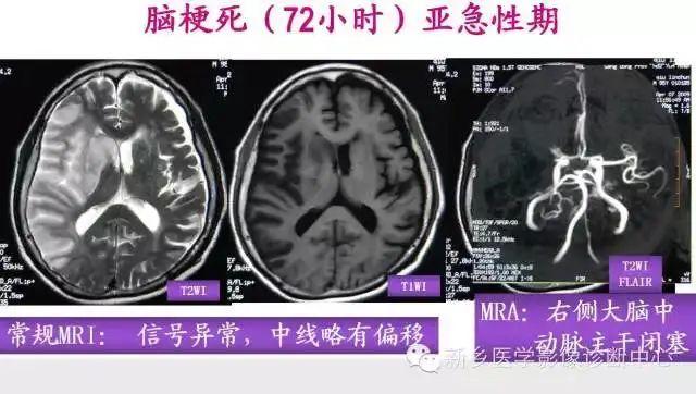 脑梗塞分期的最新标准概述